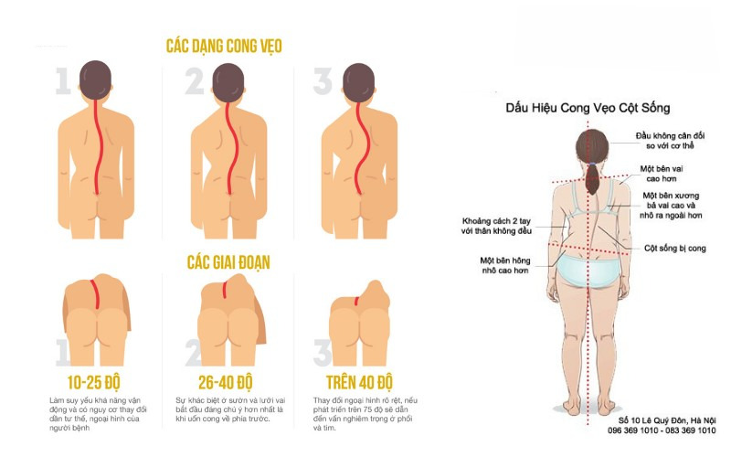 Các giai đoạn vẹo cột sống