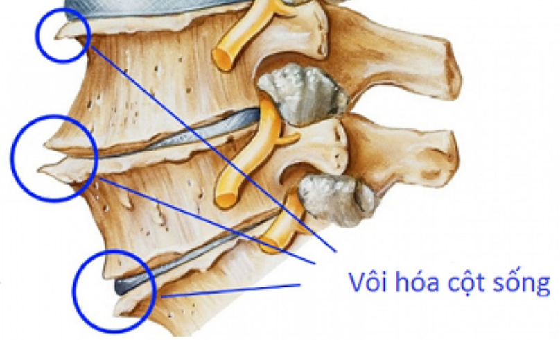 Hiện tượng vôi hoá cột sống