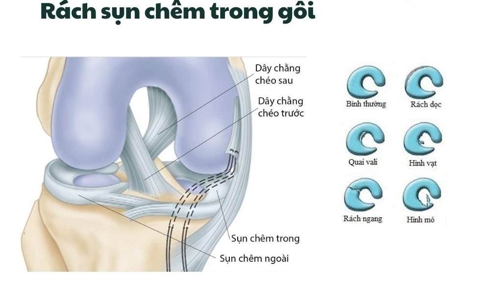 Các loại rách sụn chêm thường gặp