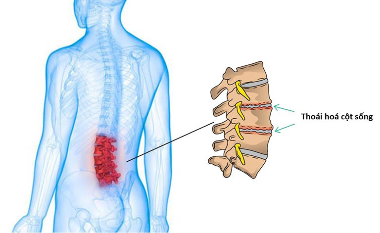 Tình trạng thoái hoá cột sống lưng