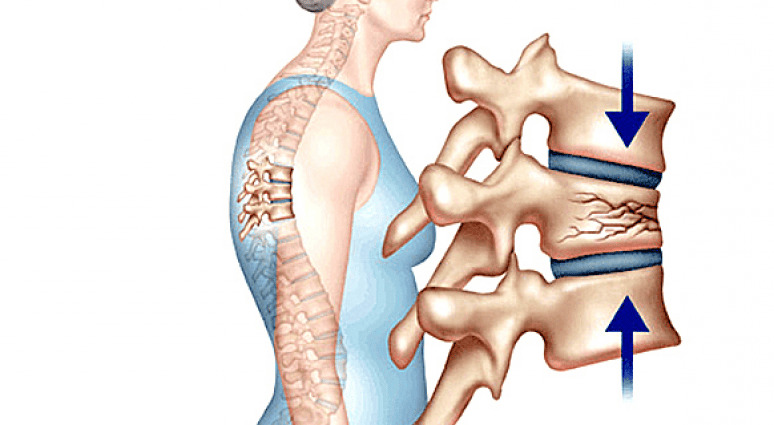Tình trạng lún xẹp đốt sống do loãng xương