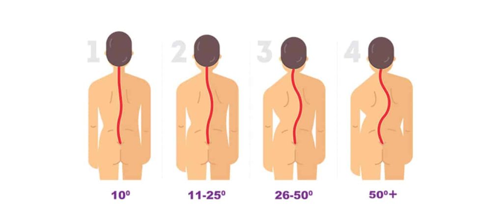 Số đo góc Cobb giúp xác định tình trạng vẹo cột sống