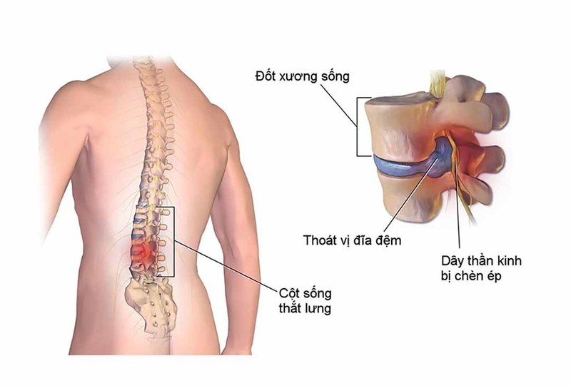 Hội chứng đau thắt lưng - hông