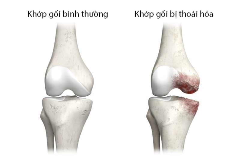 Khớp gối bị thoái hoá