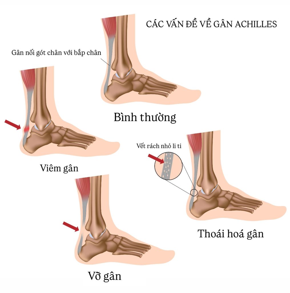 Các vấn đề về gân Achilles