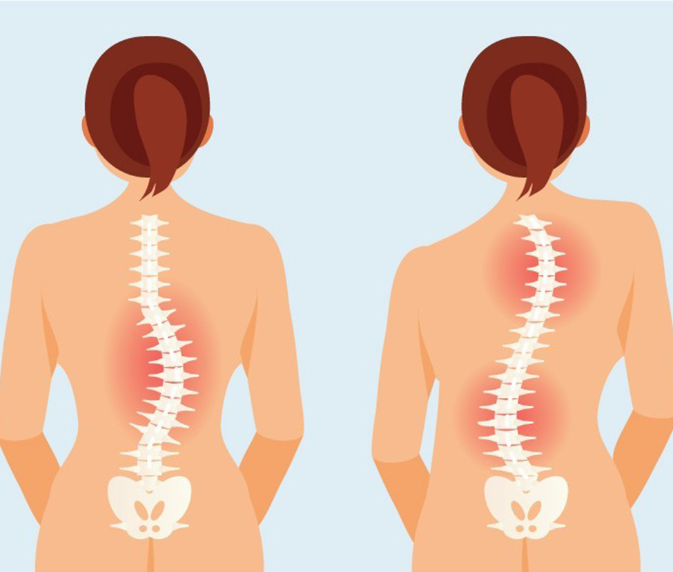 Bệnh cong vẹo cột sống