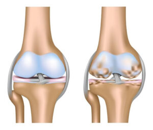 Bệnh thoái hoá khớp gối