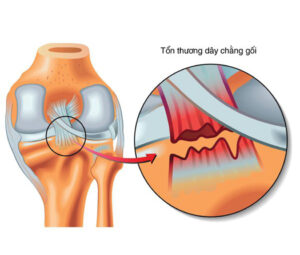 Bệnh tổn thương dây chằng chéo