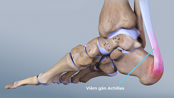 Bàn chân bẹt có thể gây ra đau và căng trên gân Achilles