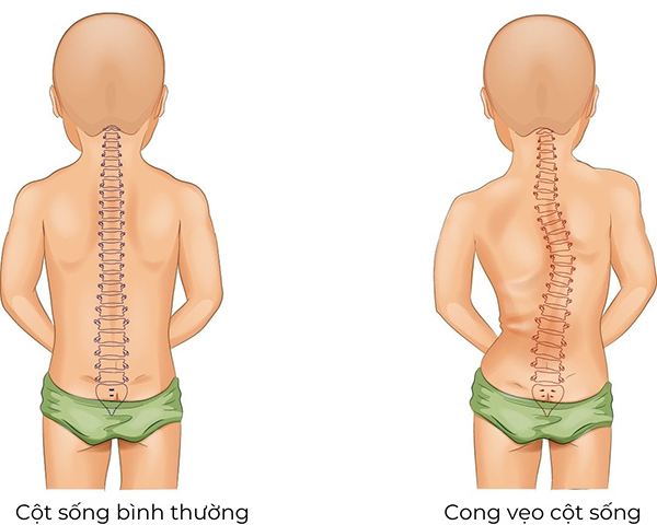 Bàn chân bẹt ảnh hưởng đến cột sống của bé