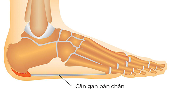 Cơ chế hoạt động của bàn chân bẹt có thể làm tăng nguy cơ phát triển viêm cân gan chân