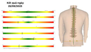 Tình trạng cong vẹo cột sống sau khi điều trị