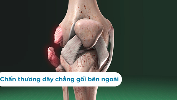 Chấn Thương Dây Chằng đầu Gối Cách Nhận Biết Và điều Trị 2466