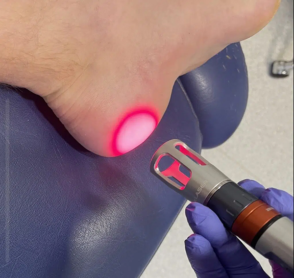 Phương pháp vật lý trị liệu gai gót chân bằng laser