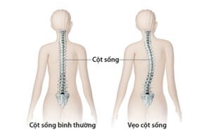 Cong vẹo cột sống
