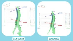 Về góc gù cột sống ngực cũng giảm được từ 35 độ xuống còn 26 độ.