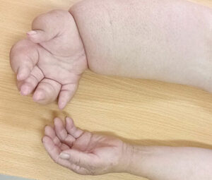 Phù mạch bạch huyết