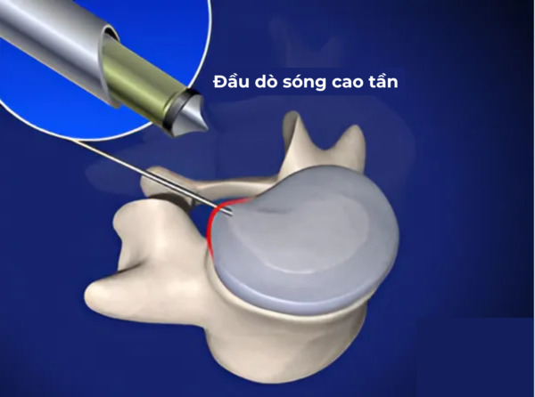 Đầu dò sóng cao tần được chọc xuyên qua bao xơ và thực hiện giải phóng nhân nhầy
