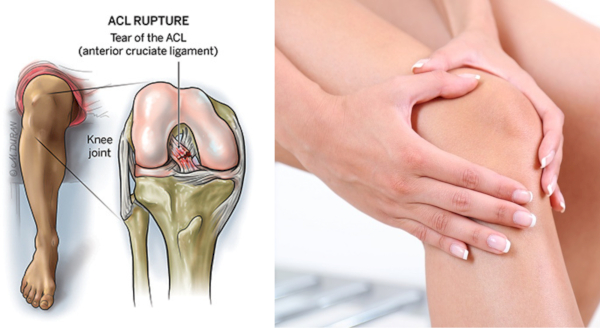 Giãn dây chằng chéo trước là tình trạng dây chằng trước gối bị kéo dãn nhưng chưa đứt hoàn toàn.