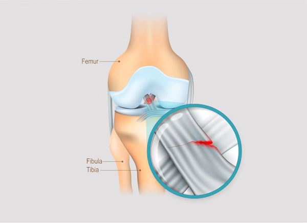 Khám cận lâm sàng cho phép quan sát rõ vết rách cũng như phát hiện các tổn thương khác liên quan đến xương