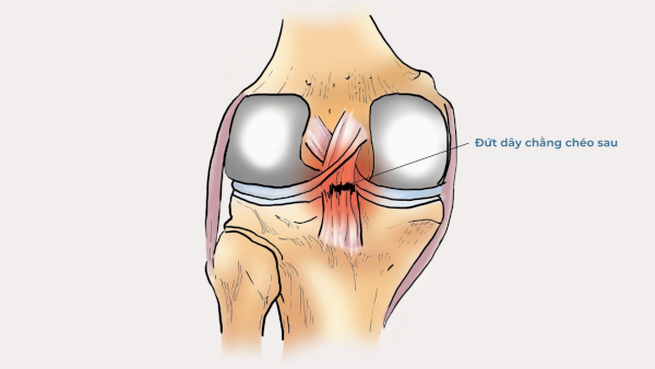 Phẫu thuật đứt dây chằng chéo sau đầu gối có thể được chỉ định tùy thuộc vào nhiều yếu tố
