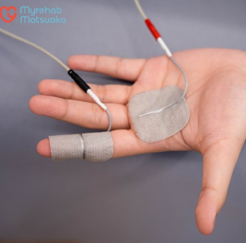 Phương pháp điện xung trong PHCN hội chứng ngón tay lò xo