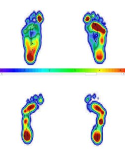 HÌnh ảnh so sánh bàn chân bẹt và bàn chân có vòm