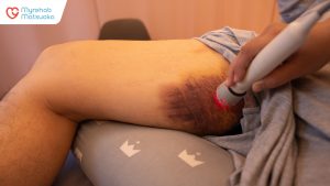 Hình ảnh tổn thương mô mềm đùi trong của anh M.