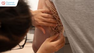 Băng dán kinesio giúp nâng mô