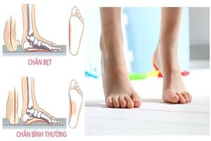 bàn chân bẹt ở trẻ