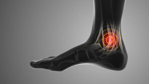 hội chứng ống cổ chân