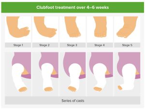 phương pháp ponseti