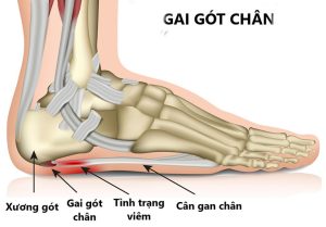 hình ảnh gai gót gây đau gót chân