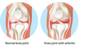 khớp gối thường và khớp gối viêm