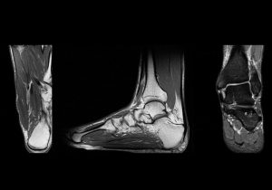 MRI cổ chân