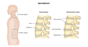 so sánh thoái hóa cột sống và cột sống bình thường