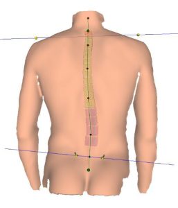 Những người bị vẹo nhẹ có thể cân nhắc luyện tập Schroth