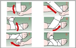 Hướng dẫn băng ép sau lật cổ chân