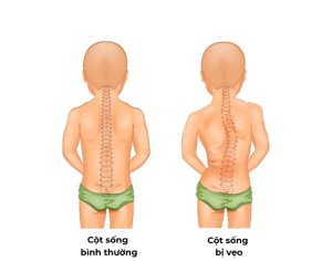 Vai lệch là dấu hiệu của cong vẹo cột sống 