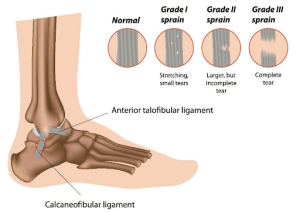 Các mức độ tổn thương dây chằng cổ chân