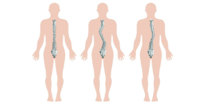 Biến chứng vẹo cột sống gây hậu quả nghiêm trọng tới sức khỏe 