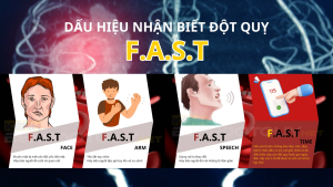 Quy tắc FAST giúp nhận biết sớm bệnh đột quỵ