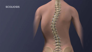 Vẹo cột sống hình chữ C xuôi