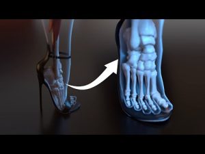 Cấu trúc bàn chân thay đổi khi mang giày cao gót trong thời gian dài