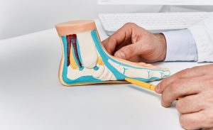 Phẫu thuật bàn chân bẹt được chỉ định khi bệnh lý ảnh hưởng nghiêm trọng tới cuộc sống người bệnh
