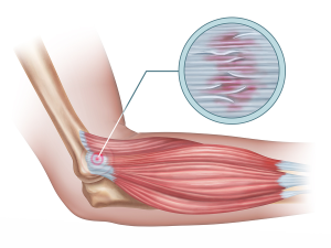 Hội chứng tennis elbow