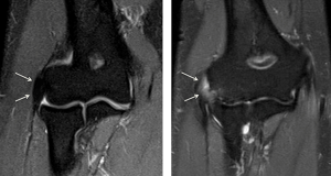 So sánh hình ảnh chụp MRI của người bình thường và bệnh nhân mắc hội chứng Tennis Elbow (bên phải)
