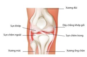 Cấu tạo cơ bản của sụn chêm