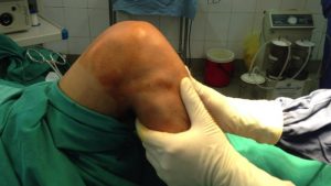 Chấn thương dây chằng chéo gây biến dạng khớp gối