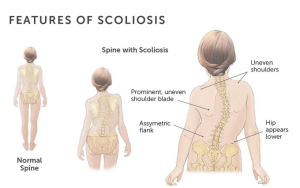 Đặc điểm của vẹo cột sống